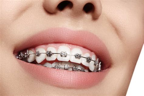 bracket metalicos|ventajas de brackets metálicos.